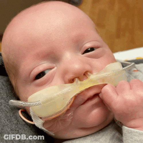 A Baby With An Oxygen Mask On His Nose Looks At The Camera GIF