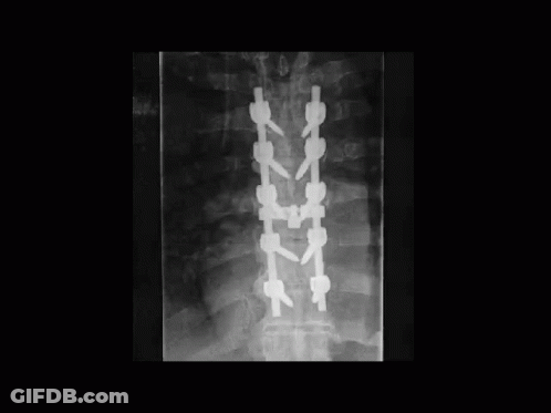 A Black And White X-Ray Of A Person 'S Spine With A Lot Of Screws On It . GIF
