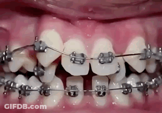 A Close Up Of A Person 'S Teeth With Braces GIF