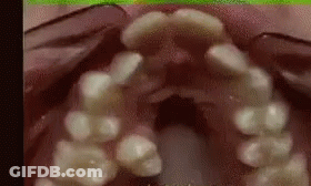 A Close Up Of A Person 'S Teeth With Braces On . GIF