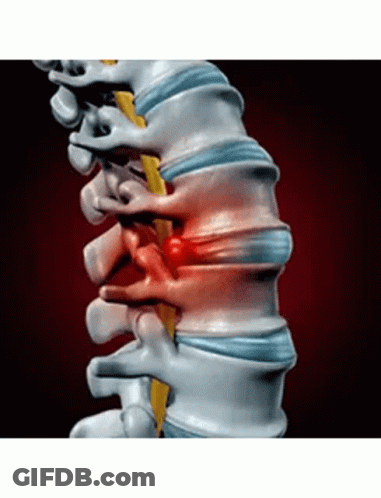 A Computer Generated Image Of A Person 'S Spine Showing A Disc In The Back Of The Spine . GIF