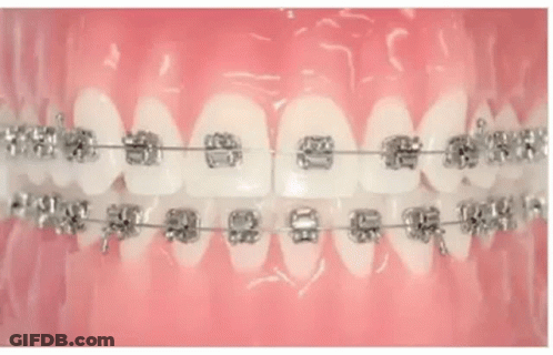 A Woman Is Wearing A Clear Retainer In Her Mouth . GIF