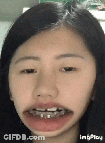 A Woman With Braces On Her Teeth Is Making A Funny Face . GIF