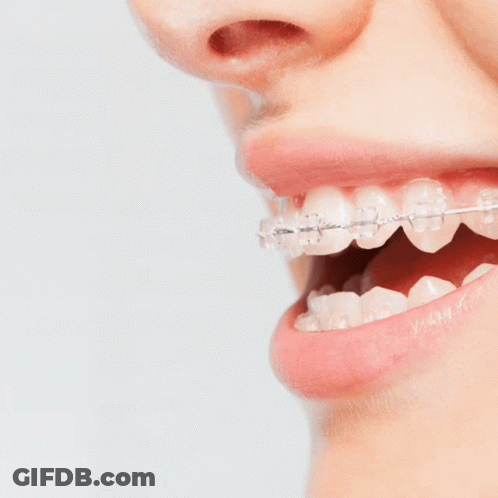 An Ad For Braces Treatment Shows A Woman 'S Teeth With Clear Braces GIF