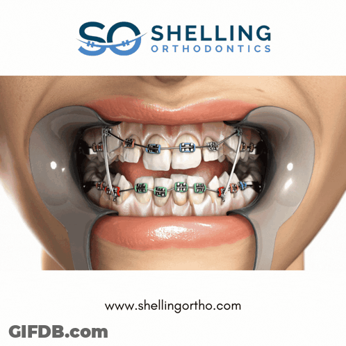 An Advertisement For Shelling Orthodontics Shows A Woman With Braces GIF