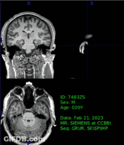 Black And White Brain February 21St 2023 GIF