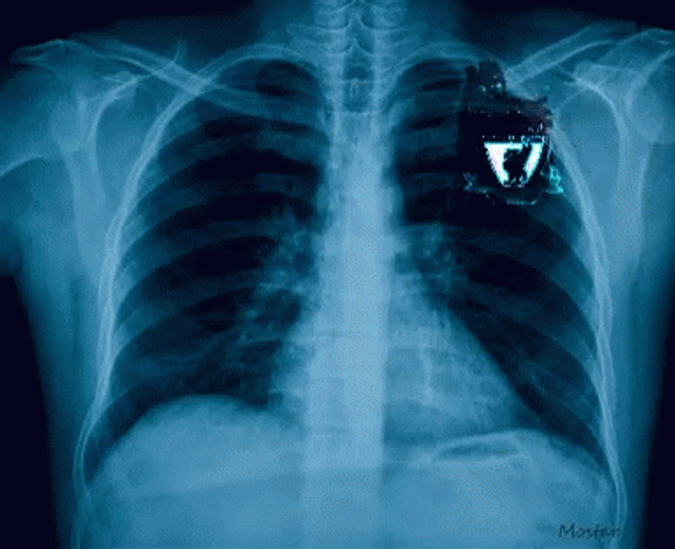Chemical Burn Lungs X-Ray GIF
