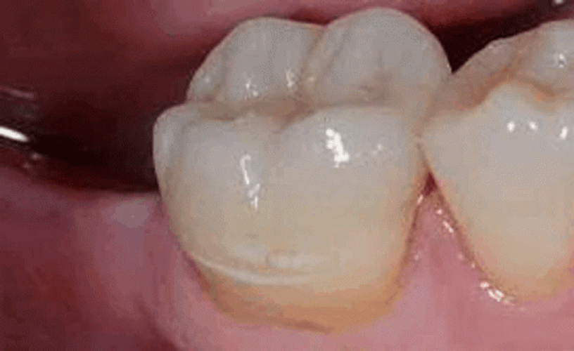 Fixed Dentures Teeth GIF