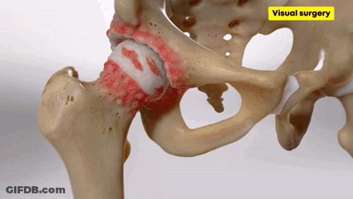 Hip Joint Model With Yellow Sticker Visual Surgery GIF