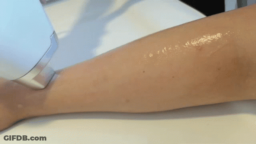 Newest Laser Hair Removal Technology GIF