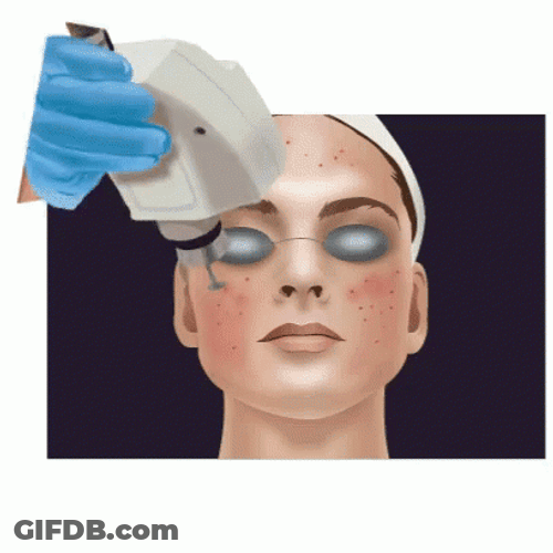 Pimple Popping Laser Treatment Animation GIF