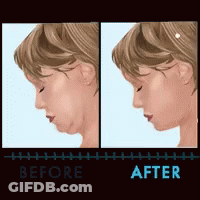 Plastic Surgery Beauty GIF