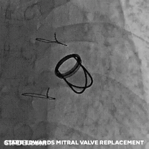 Starr Edwards Mitral Valve Replacement Drawing GIF