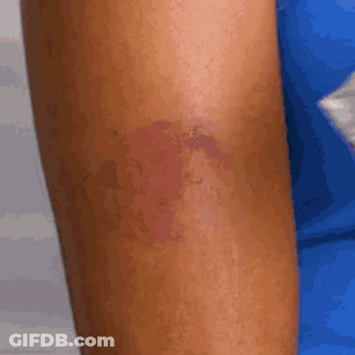 Tea Bag Used In Skin To Reduce Swelling GIF