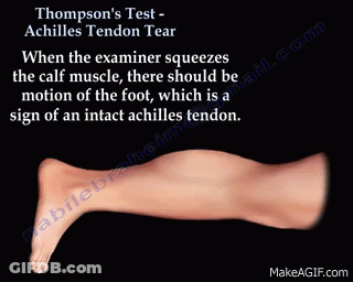 Thompson's Test Achilles Tendon Tear Squeezing Calf Muscle GIF