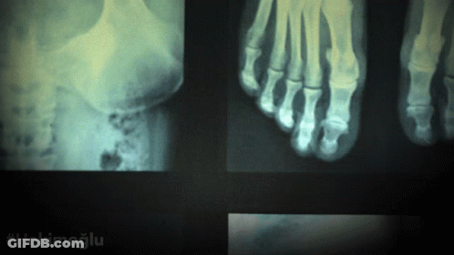 X-Ray Of Foot With Hashtag Hekimoglu GIF