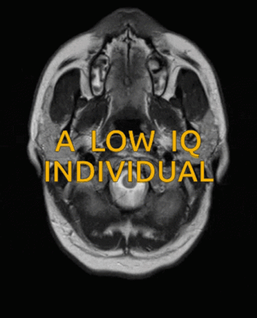 You Are An Idiot Low IQ Brain GIF