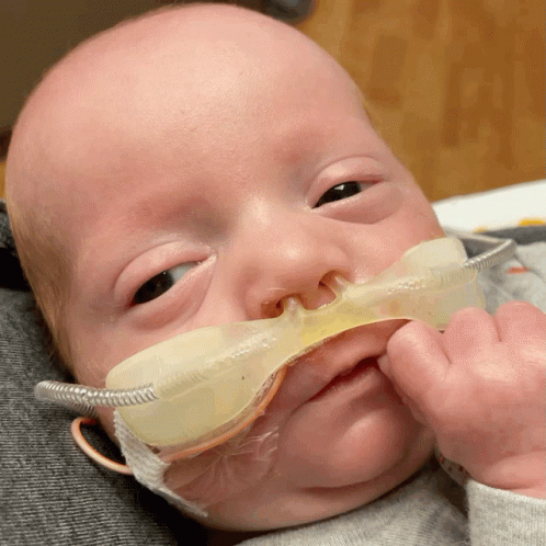 A Baby With An Oxygen Mask On His Nose Looks At The Camera GIF