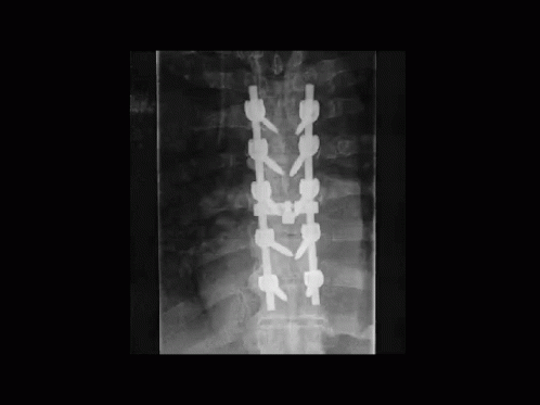 A Black And White X-Ray Of A Person 'S Spine With A Lot Of Screws On It . GIF