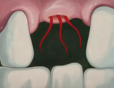 A Close Up Of A Person 'S Teeth With Blood Coming Out Of Them . GIF