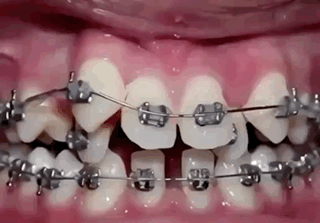 A Close Up Of A Person 'S Teeth With Braces GIF
