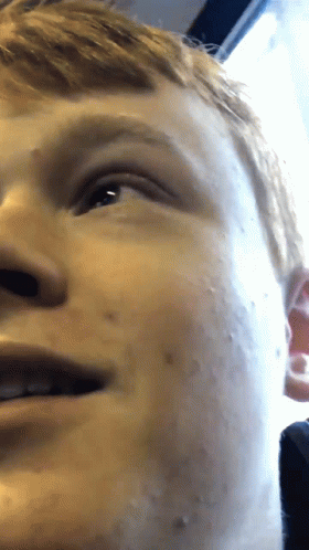 A Close Up Of A Young Man 'S Face With A Few Spots On It GIF