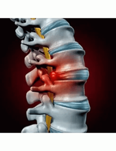 a computer generated image of a person 's spine showing a disc in the back of the spine .