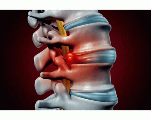 A Computer Generated Image Of A Person 'S Spine With A Red Bump On It GIF
