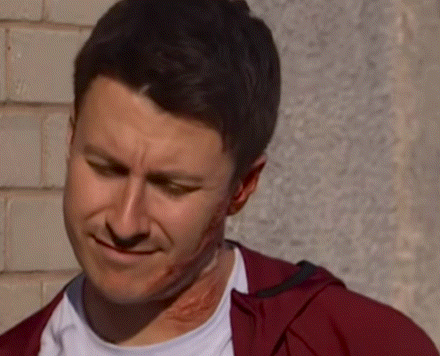 A Man With A Scar On His Face Is Smiling . GIF