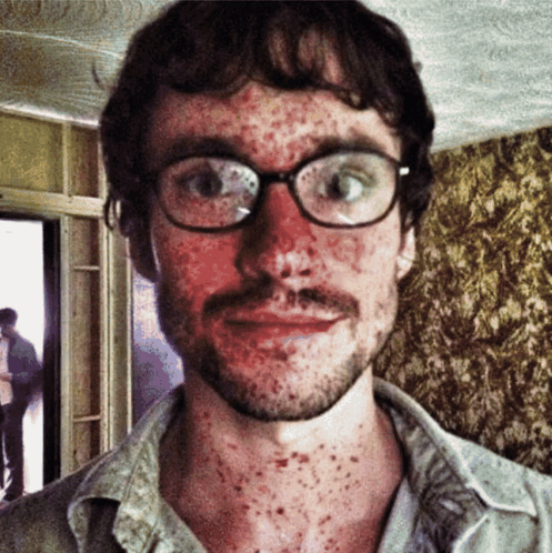 A Man With Glasses And A Beard Has Spots On His Face GIF
