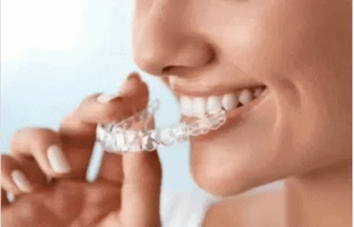 A Woman Is Wearing A Clear Retainer On Her Teeth . GIF