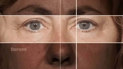 A Woman 'S Face Is Shown Before And After A Treatment GIF