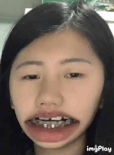 A Woman With Braces On Her Teeth Is Making A Funny Face . GIF
