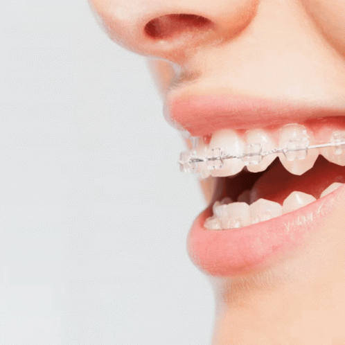 An Ad For Braces Treatment Shows A Woman 'S Teeth With Clear Braces GIF