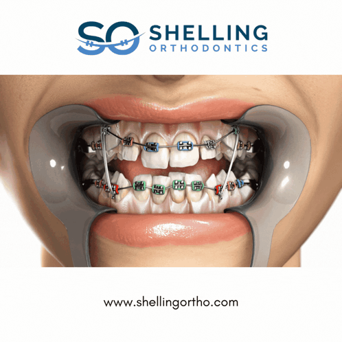 An Advertisement For Shelling Orthodontics Shows A Woman With Braces GIF