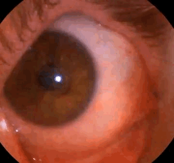 Close Up Eye With Blood Coming Out