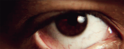 Close Up Of Brown Eye With White Pupil And Red Veins GIF