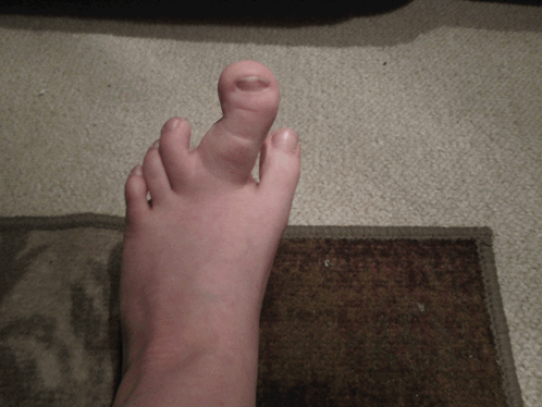 Close Up of Foot with Missing Toe