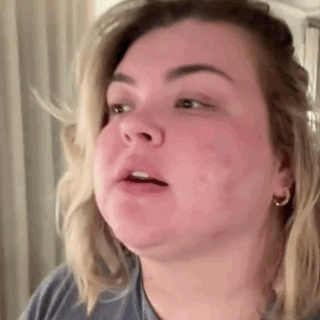 Close Up of Woman Face With Red Rash