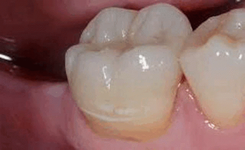 Fixed Dentures Teeth GIF