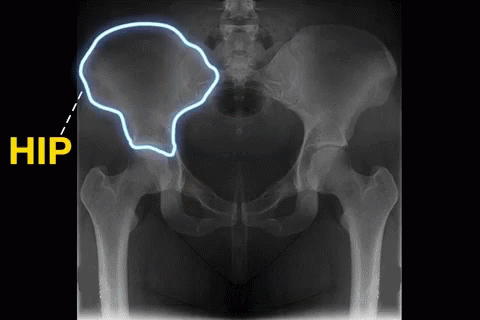 Hip Hip Hooray Pelvic Xray GIF