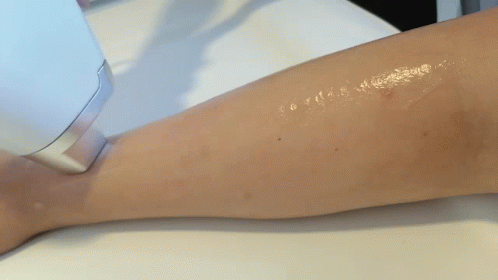 Newest Laser Hair Removal Technology GIF