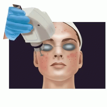 Pimple Popping Laser Treatment Animation GIF
