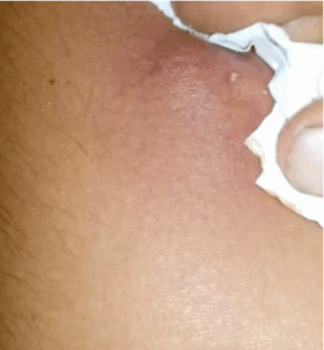 Pimple Popping Abscess Removal GIF