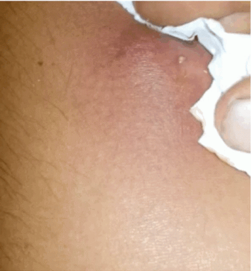 Pimple Popping Abscess Removal GIF