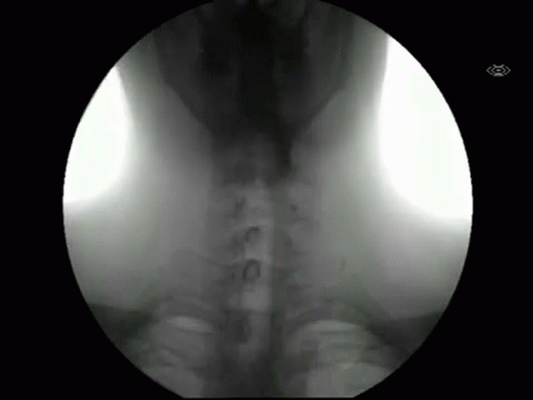 Swallow Liquid Passing The Throat GIF