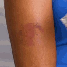 Tea Bag Used In Skin To Reduce Swelling GIF