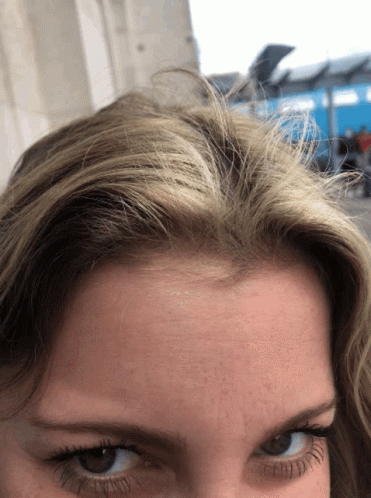 Woman's Forehead With Blue Sky
