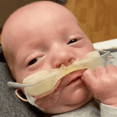 A Baby With An Oxygen Mask On His Nose Looks At The Camera GIF