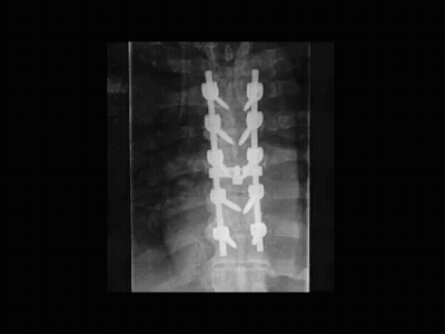 A Black And White X-Ray Of A Person 'S Spine With A Lot Of Screws On It . GIF